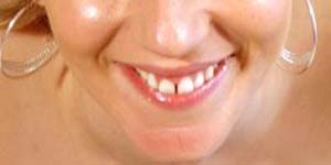 sourire de star